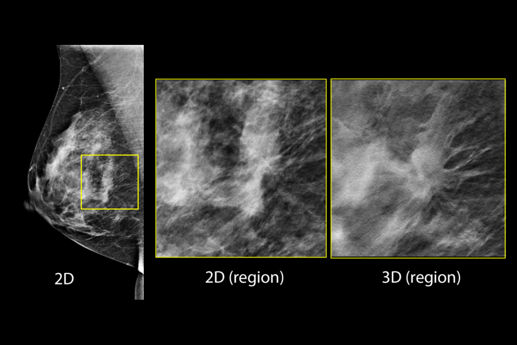 Kliniska bilder av bröst med misstänkt lesion