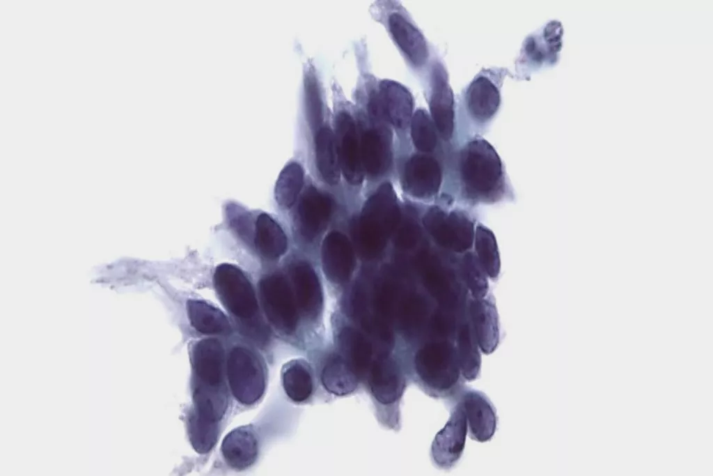 Cellprov med glandulär intraepitelial neoplasi i cervix