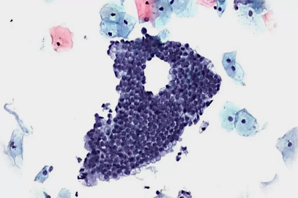 Negativt cellprov med endocervikala celler