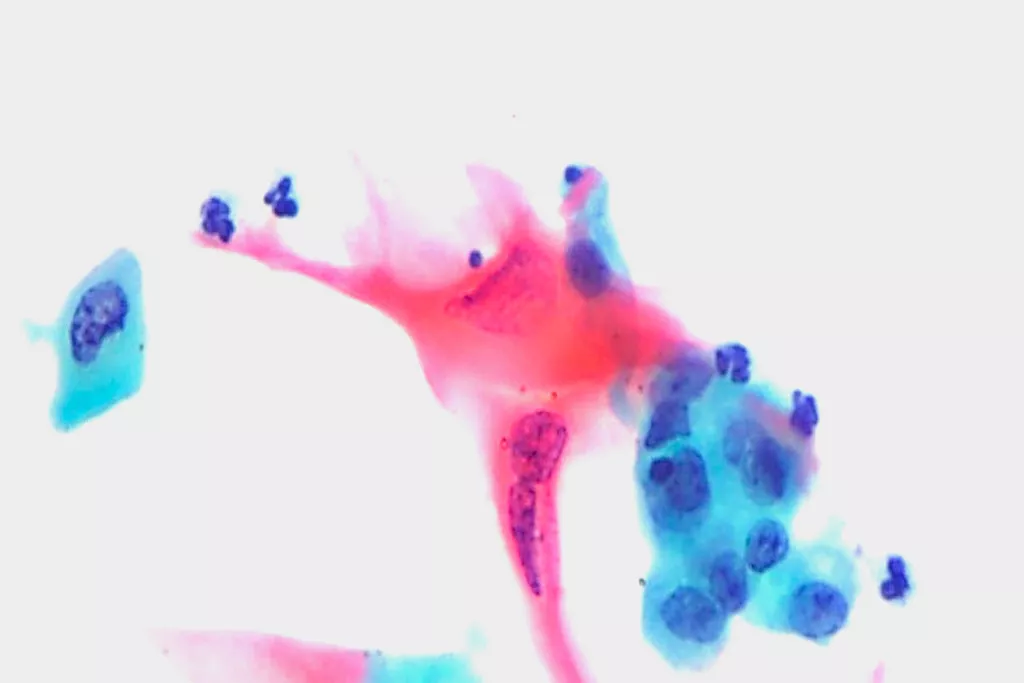 Skivepitelkarcinom, urin, Papanicolaou-färgning