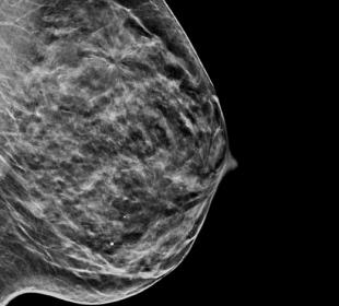 Hologic C-View™ Synthesised 2D Imaging mot vit bakgrund