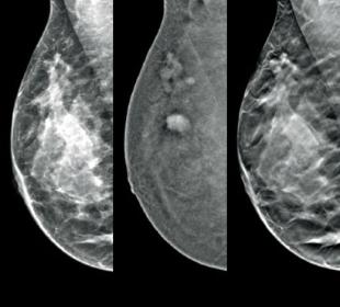 Hologic I-View™ Contrast Enhanced Imaging